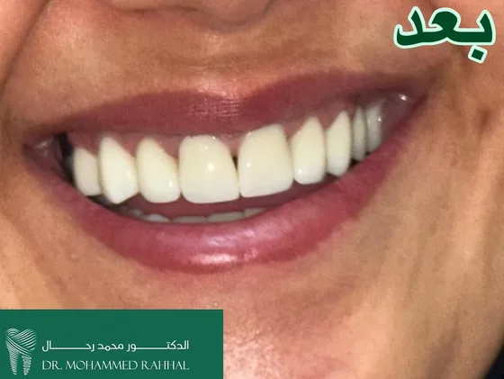 صورة الابتسامة بعد العلاج في الحالة الأولى