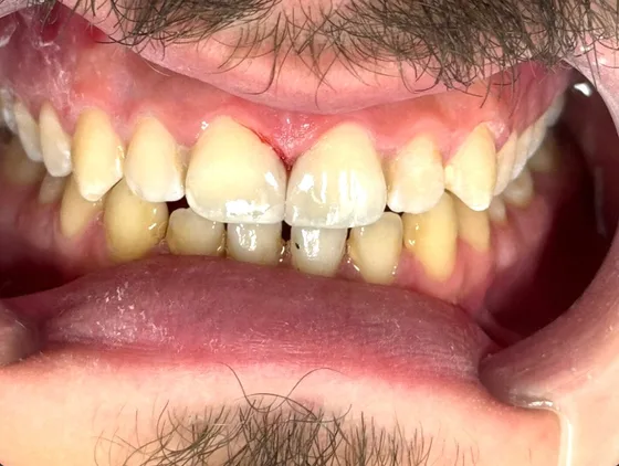 صورة الابتسامة بعد العلاج في الحالة الثانية