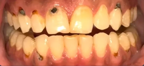 صورة السن قبل العلاج في الحالة الثالثة