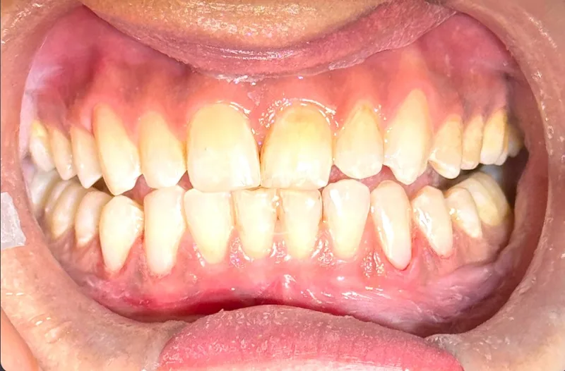 Upper central incisor trauma case
