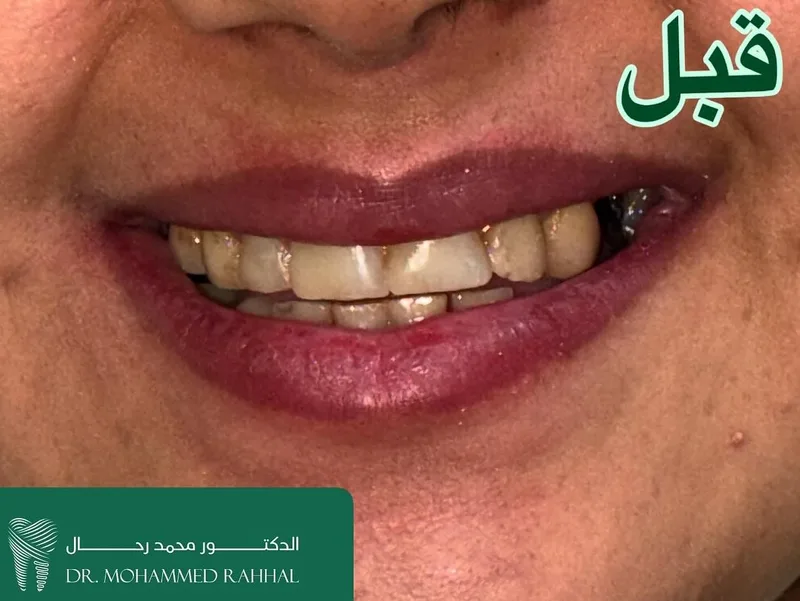 Lower-left first molar — retreatment case